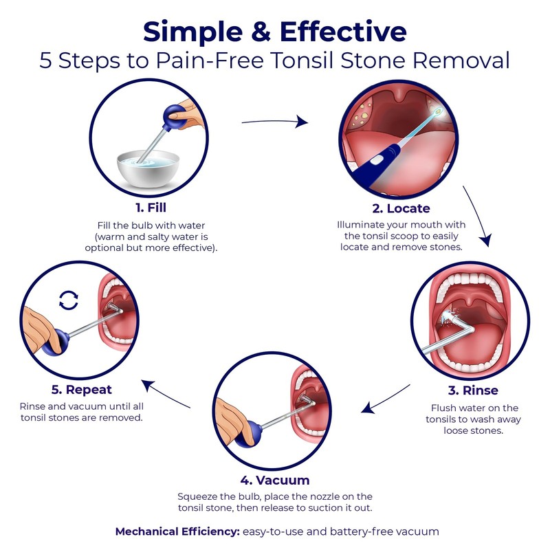 Oravix Tonsil Stone Vacuum, Remover Vacuum Suction, Tonsil... gallery